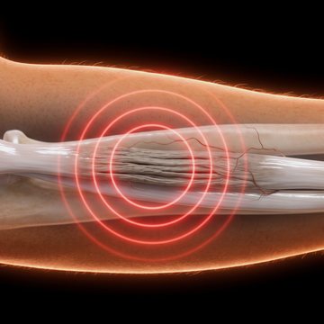 Codo con el tendón extensor