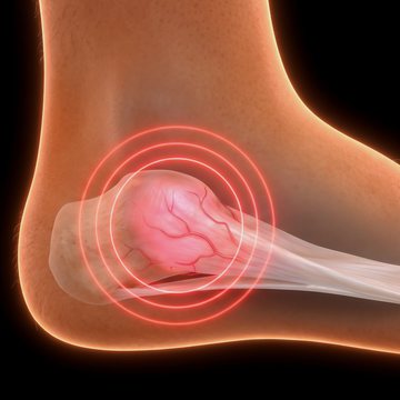 Talón con la fascia plantar